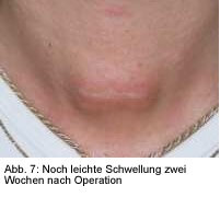 M_Schilddruese_Wundheilung_Schwellung_Operation.jpg
